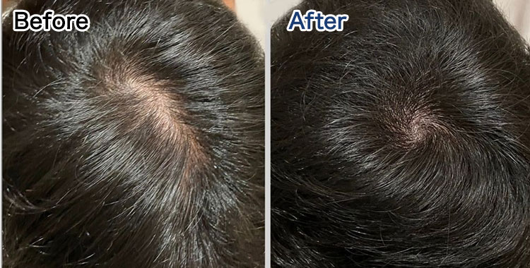 頭皮にタトゥーのような施術を施すことで、薄毛や円形脱毛症を目立ちにくい状態にする施術。｜スカルプインク沖縄